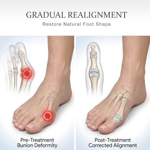 Gray 2-Pack Bunion Corrector & Silicone Toe Separators for Hallux Valgus, Overlapping Toes, Hammer Toe Relief — Adjustable Knob & Day Use