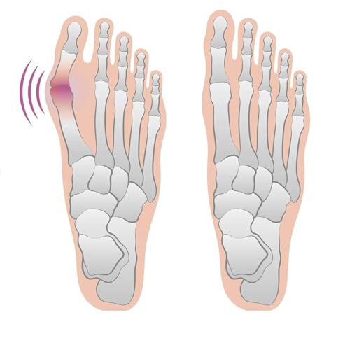 Bunion Relief Sleeves - 2 Pairs with Cushion Pads