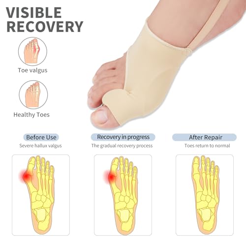 Bunion Corrector and Toe Straightener Splint - 2 Pack - Beige