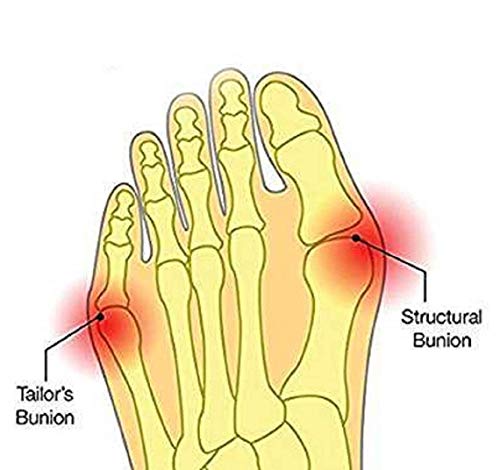 Bunion Relief Sleeves with Gel Cushion - Foot Care Tool