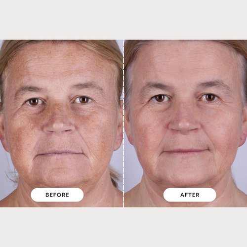 CurrentBody Skin LED Light Therapy Mask - Advanced Skin Rejuvenation | Series 2