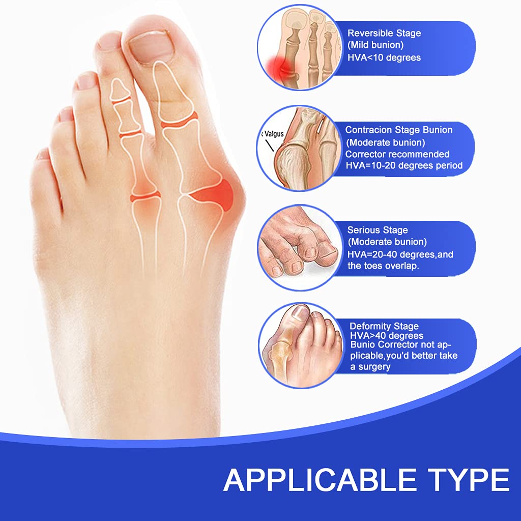 Toe Corrector Toe Separator Bunion Splint 【Updated Version】 Hallux Valgus Big Toes Corrector Set Bunion Brace Bunion Exercise Strap Orthopedic Kit Pain Relief (Blue, free)