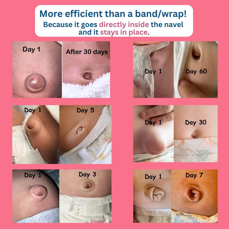 Premium Patented Baby Belly Button Plug | Ultra-Soft Silicone Belly Button Shaper Plug | Reusable and Perfect Size for All Newborns | No Patches | Freedom to Move, Breathe and Sleep | Baby Essentials