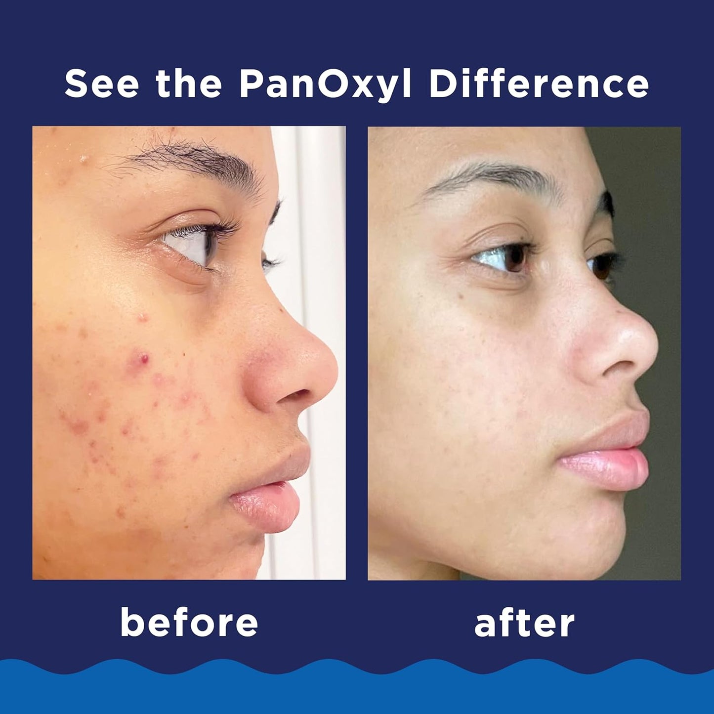 PanOxyl Acne Foaming Wash - 10% Benzoyl Peroxide Maximum Strength Cleanser | 5.5 Oz Tube for Clear Skin