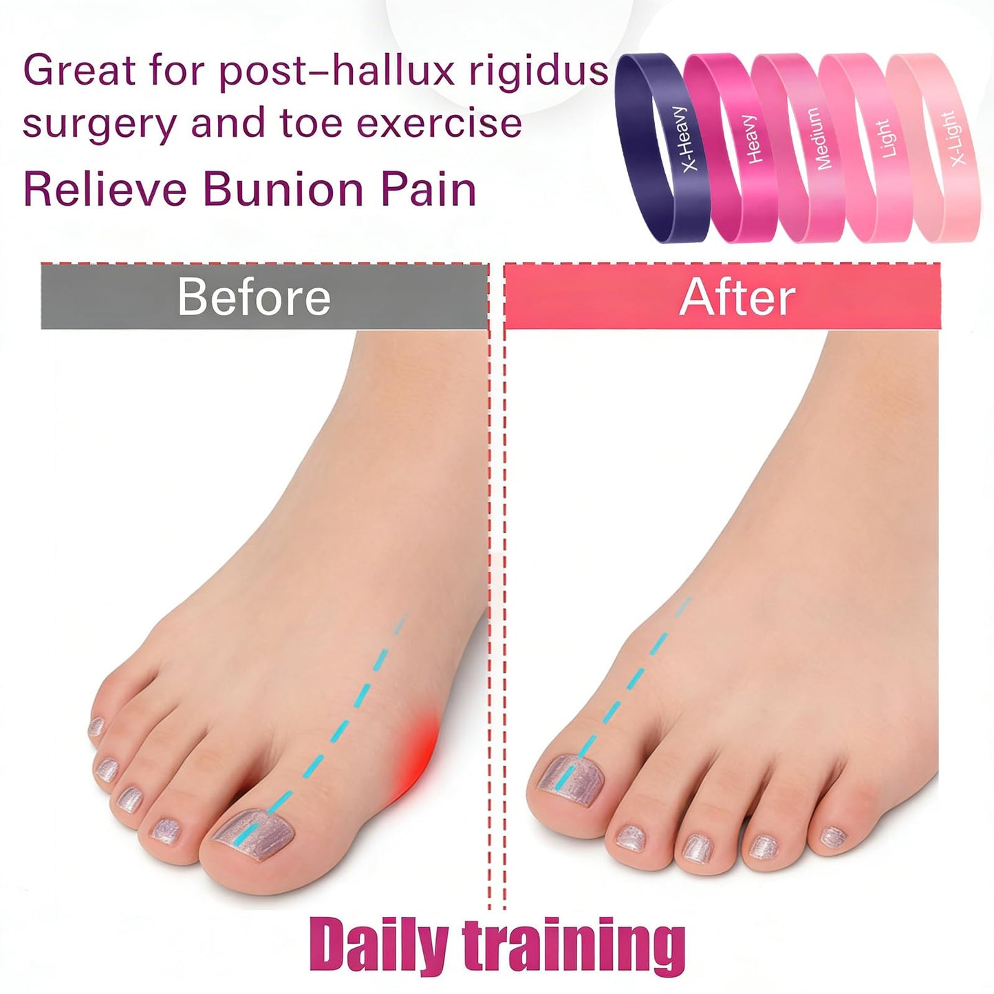 20 Pcs Toe Stretcher Bands for Bunions, 5-Level Resistance Toe Spacers for Hallux Valgus, Foot Pain Relief & Yoga Fitness for Men/Women (Multi-Color)