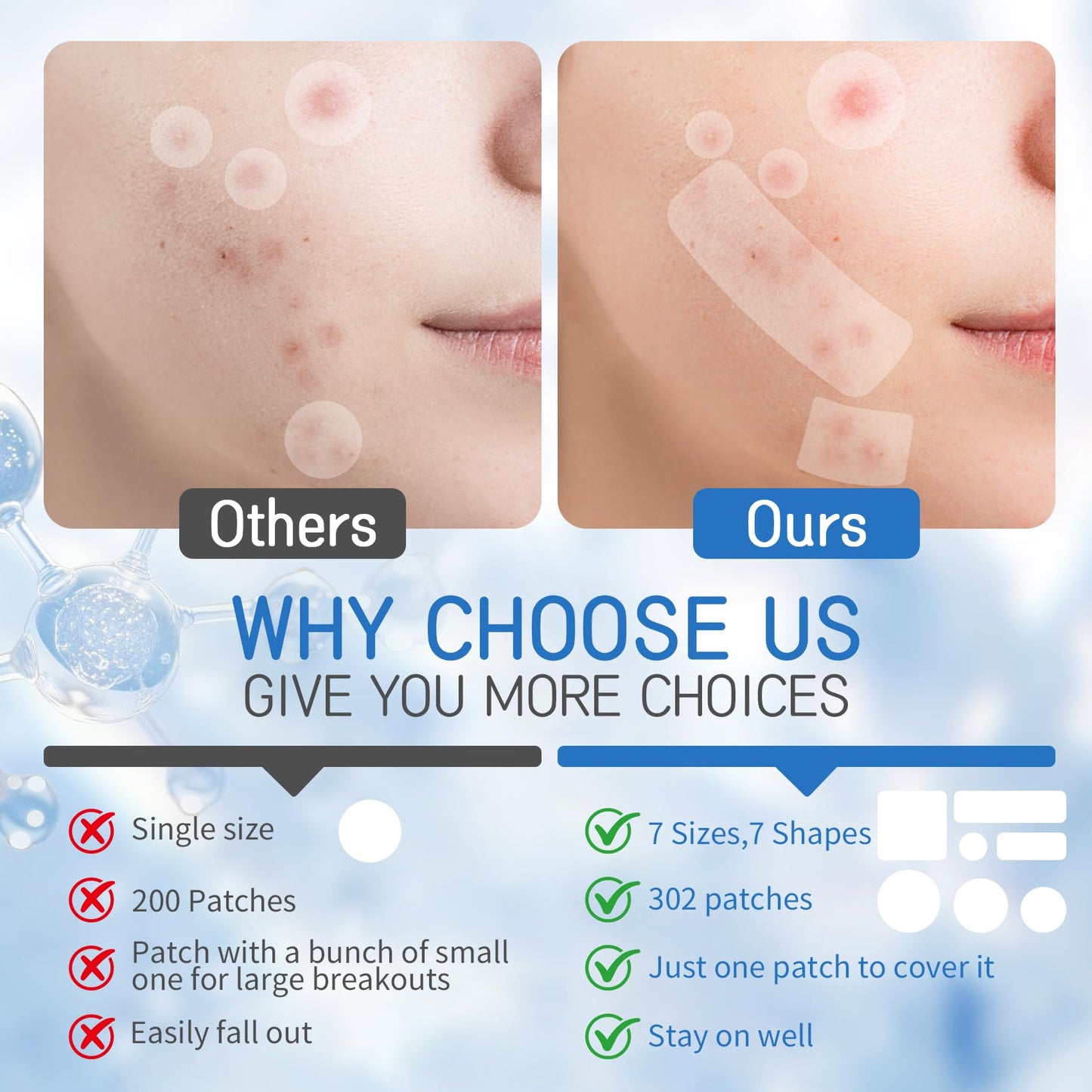 Large Pimple Patches for Face, 7 Sizes XL Acne Patches Big Hydrocolloid Bandages for Body, Chin, Forehead, Chest, Back Zit Breakouts (Strip, Square, Round 302 Count)