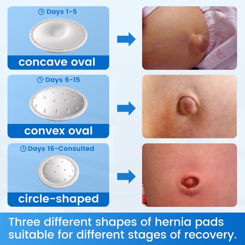 Velpeau Umbilical Hernia Belt Baby Newborn -with 3 Different Shaped Compression Pads, Belly Button Navel Band Wrap Truss Abdominal Binder Support for Infant, Children, Toddler, Kids (Khaki-Reg)