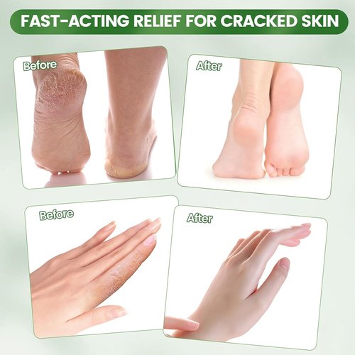 DooWee Aloe Vera Cracked Skin Patches - 50 Large 3x2 Inch Hydrating Bandages for Dry Heels & Hands