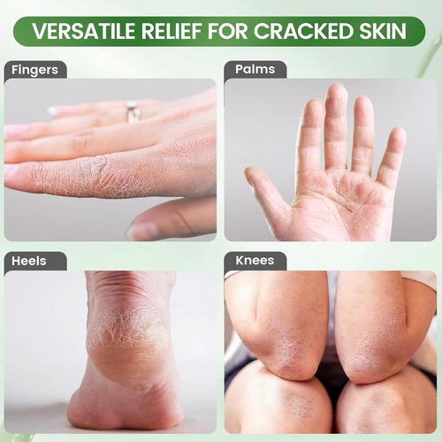 DooWee Aloe Vera Cracked Skin Patches - 50 Large 3x2 Inch Hydrating Bandages for Dry Heels & Hands