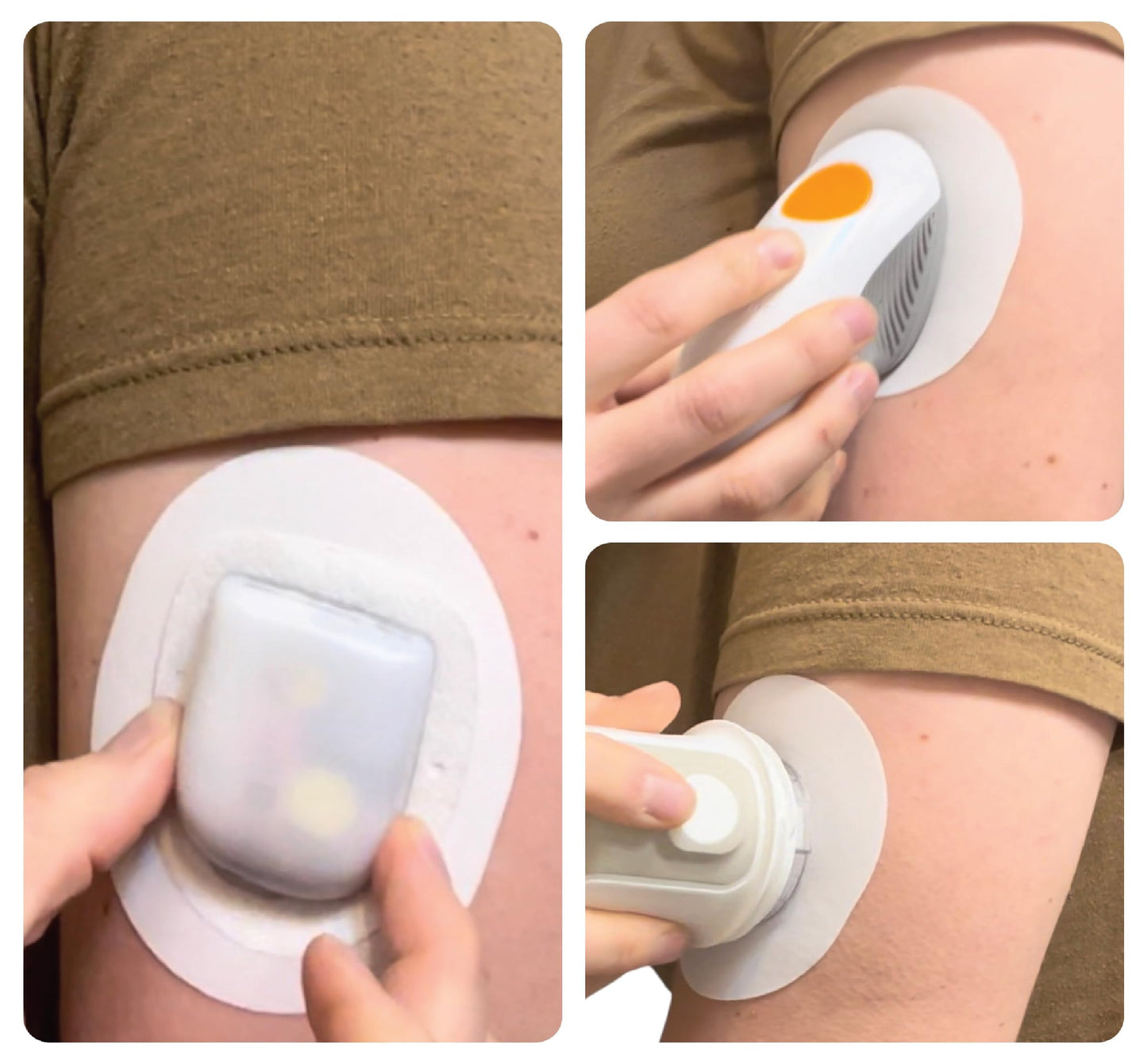 Glucomart Universal Adhesive Underpatch for Dexcom G6 & Dexcom G7, Guardian, Libre CGM sensors, and Omnipod Hypoallergenic - 10 Pack Adhesive Barrier Patches for People with CGM Adhesive Allergies