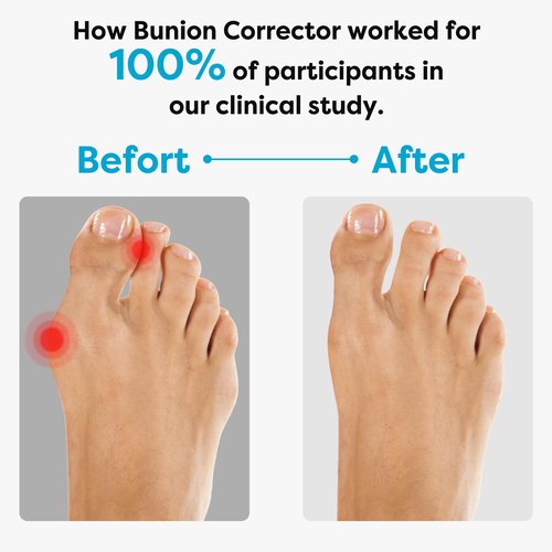 FURTAA Bunion Corrector for Overlapping big Toes,Big Toe Straightener,Bunion Splint,for Bunion Relief,Hallux Valgus Pain Relief,Comfortable & Breathable. (Black, MIDDLE:MEM(5-7)/WOMEN(7-9))