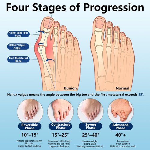 Recovist Bunion Brace Pro 2.0 for Women & Men, Adjustable Bunion Corrector Big Toe Straightener for Left & Right Foot, Say Goodbye to Hallux Valgus (Black, 1 Pair)