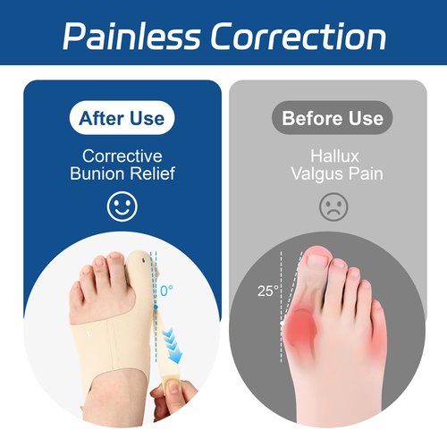 RANDY SUN 2PCS Bunions Corrector for Men Women, Adjustable Toe Separator Splint for Hallux Valgus Relief, Daytime Wear in Shoes – Soft & Breathable Material, Left & Right Foot Pair, Large