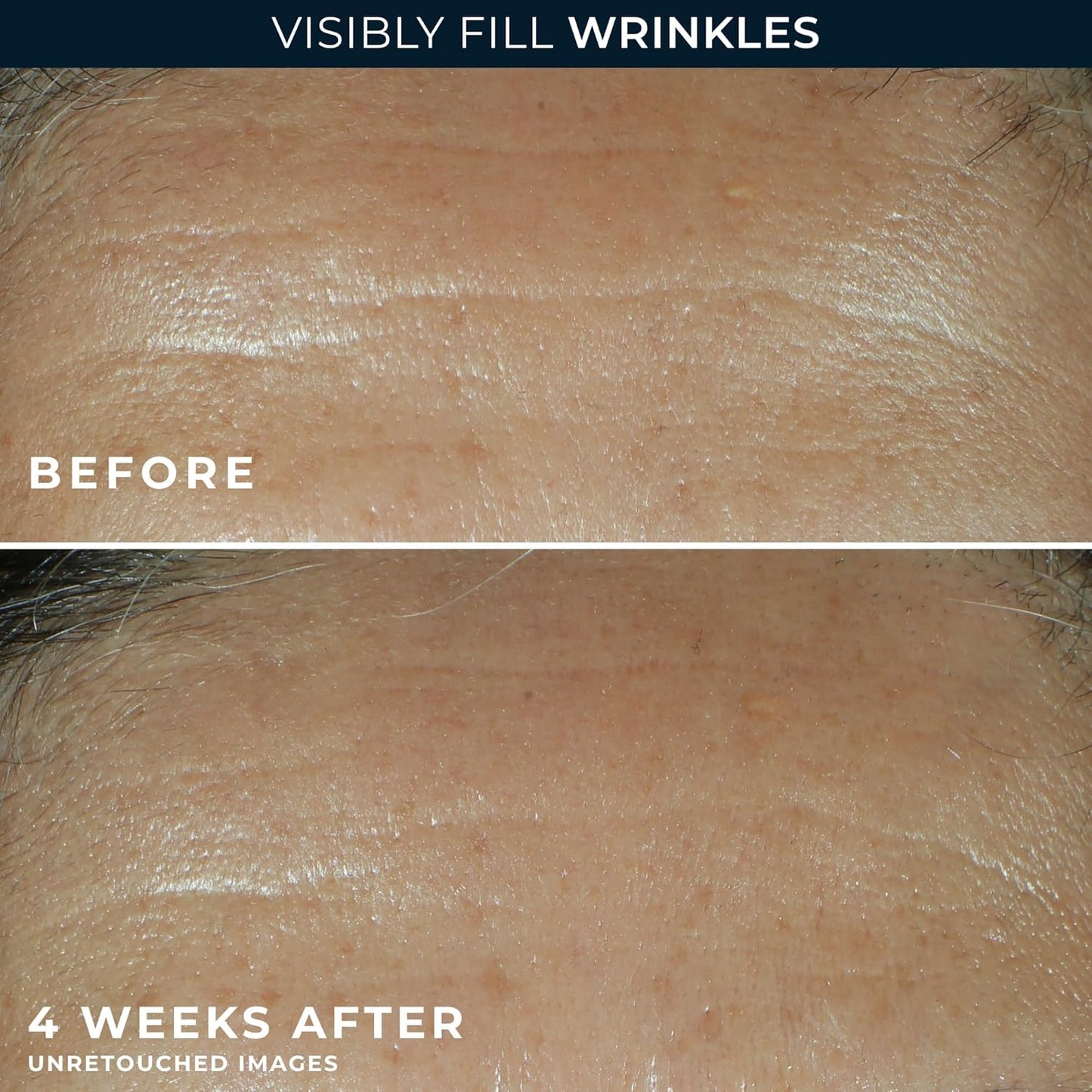 RoC Retinol Correxion Wrinkle Filler - Deep Wrinkle Treatment with Hyaluronic Acid | 1 Fl Oz