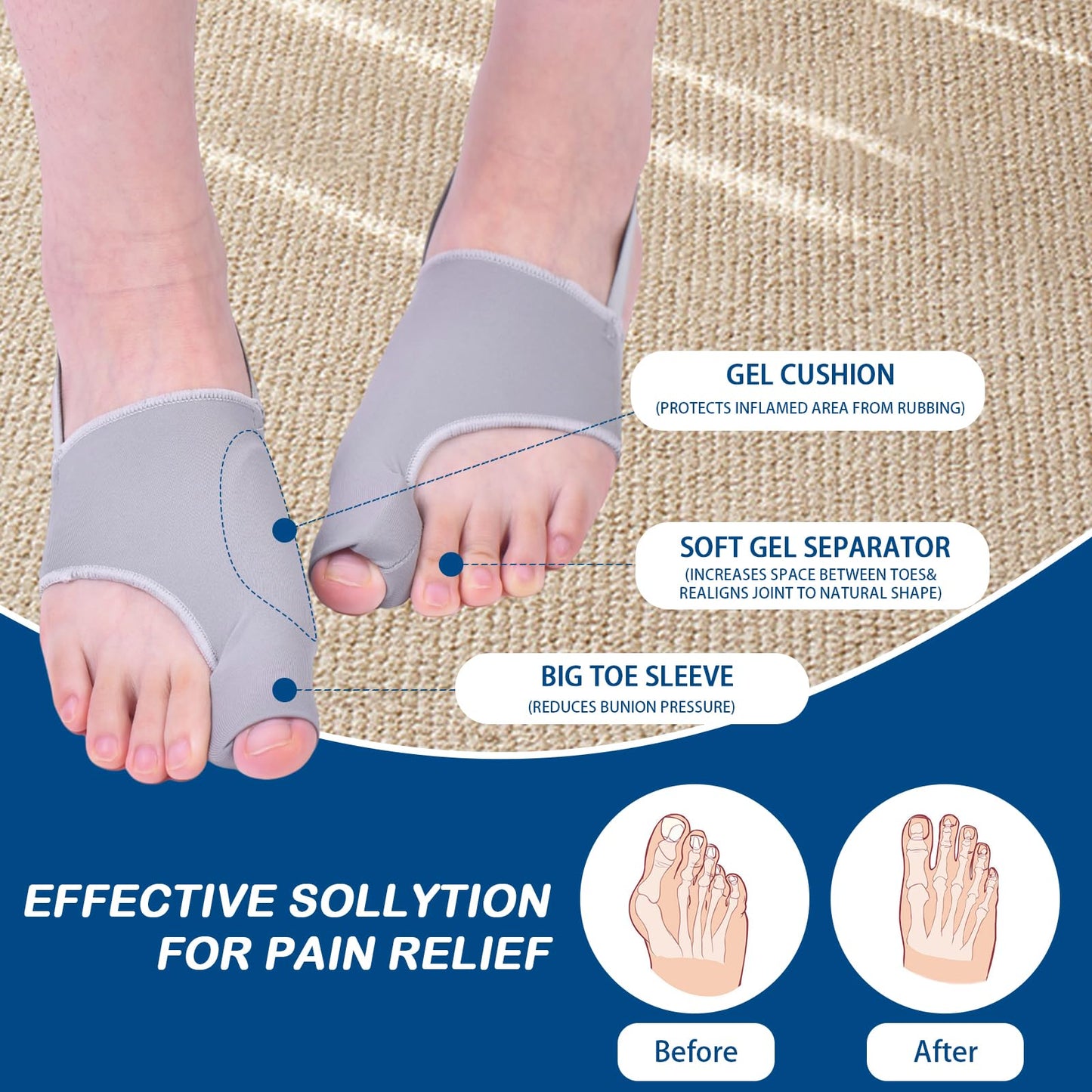 HHBOXIU Hallux valgus correction device, toe correction device. Suitable for both men and women for the correction of hallux valgus. Hallux valgus splint (gray)
