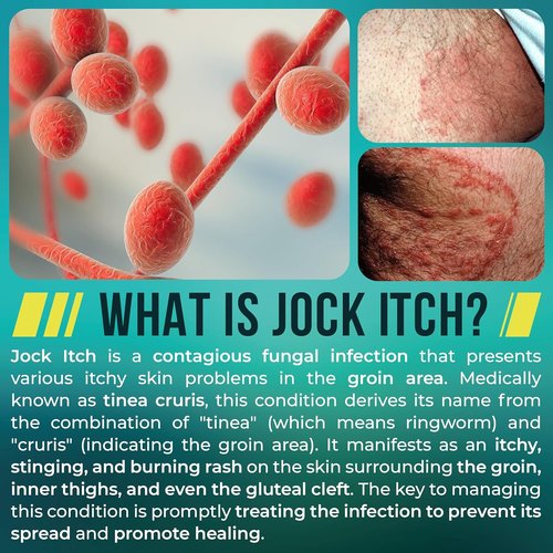 Jock Itch Spray - Antifungal Relief for Itchy Skin | Soothes Groin & Inner Thighs | Fast Absorption